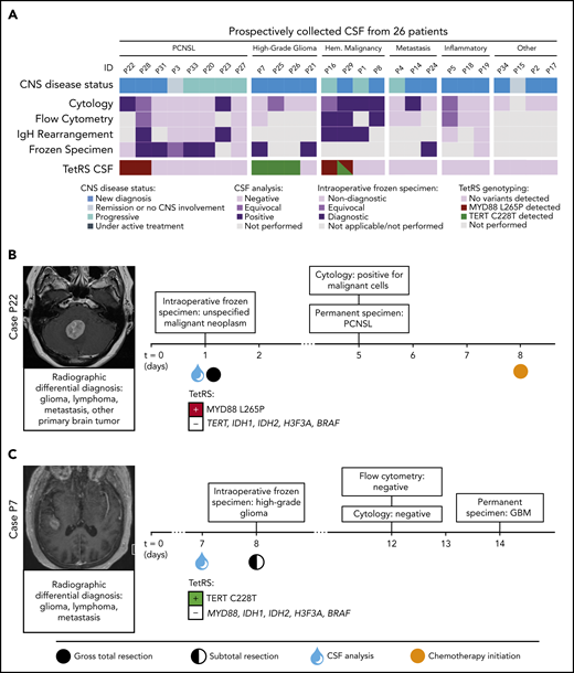 Detection of PCNSL- and glioma-specific somatic variants with the TetRS rapid genotyping assay in prospectively collected liquid biopsies. (A) The top row of segmented color bars displays the CNS disease status. The next 4 rows represent the results of routine clinical CSF studies and intraoperative frozen histopathology. The bottom row shows the mutant alleles detected in CSF by the TetRS rapid genotyping assay. Expanded results are shown in supplemental Figure 8. (B) Case P22 shows detection of the MYD88 L265P mutation in CSF from a patient with a cerebellar mass, who underwent gross total resection due to nondiagnostic intraoperative frozen specimen analysis. Cytology and permanent histologic analysis revealed PCNSL 4 days postoperatively. (C) Case P7 shows detection of the TERT C228T mutation in the CSF of a patient with a right temporal mass. Surgical needle biopsy was concluded after intraoperative frozen analysis showed high-grade glioma but converted to open craniotomy and subtotal resection due to intraoperative bleeding. GBM, glioblastoma multiforme; HGG, high-grade glioma.