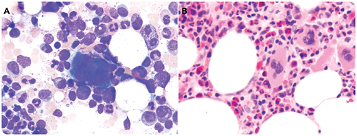 An 82-year-old woman with severe transfusion-dependent macrocytic anemia for 1.5 years was assessed for myelodysplastic syndrome (MDS). She had no radiation, chemotherapy, alcohol or drug usage, lymphadenopathy, or hepatosplenomegaly. Hypothyroidism and vitamin B12 and iron deficiency were ruled out. Her complete blood count showed the following: white blood cells, 5.5 × 109/L; hemoglobin, 76 g/L; mean corpuscular volume, 98.2 fL; reticulocytes, 3 × 109/L; platelets, 336 × 109/L; and neutrophils, 4.09 × 109/L. Blood smear was normal. Bone marrow (BM) aspirate illustrated normal megakaryopoeisis/granulopoiesis without dysplasia. Erythropoiesis was lacking with rare erythroprecursors (panel A; May-Grunwald-Giemsa stain, original magnification ×50). BM biopsy showed absence/markedly decreased erythropoiesis (panel B; hematoxylin and eosin stain, original magnification ×20) confirmed by E-cadherin/hemoglobin A staining. CD34/CD117/MPO/CD3/CD20/Parvo-B19 demonstrated no intrinsic marrow pathology. Flow cytometry demonstrated a mild reversed CD4/CD8 without clonality. T-cell receptor results were nonclonal. Karyotype analysis illustrated monosomy X in 10 out of 20 metaphases. Her history of several pregnancies rendered unrecognized Turner syndrome unlikely. This level of monosomy X (50%) is distinct from the sporadic low levels (<10%) routinely seen in peripheral blood lymphocytes. Monosomy X is reported in MDS/AML as a marker of clonal expansion in BM. Other congenital or secondary causes of pure red cell aplasia (PRCA) were ruled out. A diagnosis of myelodysplastic PRCA was suggested based on the clinical presentations/laboratory tests/BM/cytogenetics.