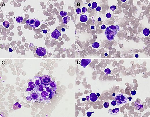 An 11-month-old infant was referred for severe neutropenia of 2-month duration, which was discovered after repeated infections. The blood count showed severe neutropenia (neutrophils 0.1 × 109/L) without anemia or thrombocytopenia. Quantitative immunoglobulin (ie, IgG, IgA, IgM) testing and lymphocyte immunophenotyping results were normal. Examination of the bone marrow revealed a hypercellular marrow that appeared to be reactive with no qualitative abnormality of the marrow cell lines. Granulocytic precursors were increased until the metamyelocyte stage. Strikingly, numerous activated macrophages containing 1 or several neutrophils inside cytoplasmic vacuoles were observed (panels A-D; May-Grünwald-Giemsa stain; 63× objective lens). This selective phagocytosis of neutrophils by marrow macrophages was suggestive of an autoimmune mechanism. Neutrophil-specific autoantibodies against CD16 were detected with an assay for the monoclonal antibody immobilization of granulocyte antigens. A diagnosis of autoimmune neutropenia (AIN) was confirmed.