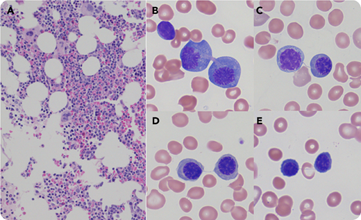 A 4-year-old boy presented with congenital cleft palate as part of Pierre-Robin sequence, cutis aplasia, hypoplastic distally set first digits, as well as syndactyly of his second and third digits. Bone marrow (BM) biopsy showed slight hypocellularity for age with trilineage hematopoiesis and decreased myeloid-to-erythroid ratio (panel A; original magnification ×100; hematoxylin and eosin stain). BM smears showed frequent nuclear bridging in erythroblasts at different maturation stages (panels B-E; original magnification ×1000; Wright-Giemsa stain). No overt dyspoiesis was seen in granulocytic linage and megakaryocytes. Chromosome analysis showed spontaneous chromatid breakage. Fluorescence in situ hybridization analysis for myelodysplastic syndrome (MDS) panel was negative. He was diagnosed with Fanconi anemia (FA) when genetic testing of his BM revealed a familial homozygous pathogenic FANCG variant c.1642C>T (p.R548*). Microarray analysis was unremarkable. The protein transcribed from FANCG is 1 of 8 involved in the FA core complex that attracts repair proteins to damaged DNA.