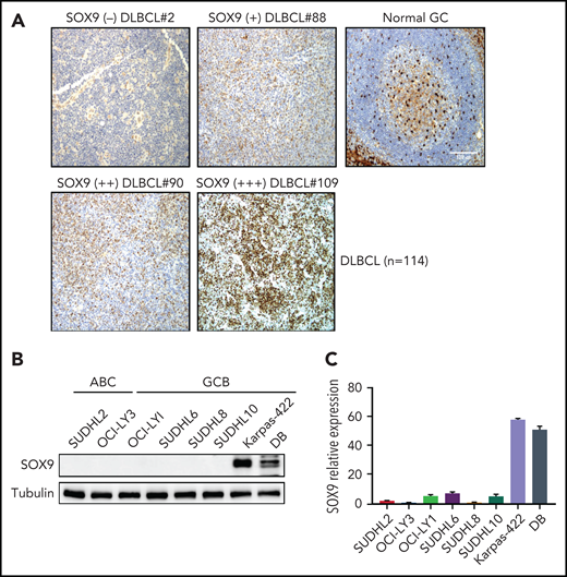 IGH-BCL2+DLBCLs manifest high levels of endogenous SOX9. (A) immunohistochemical staining of SOX9 protein in tissue samples from a DLBCL cohort (n = 114). Original magnification ×200. Bar represents 100 μm. SOX9 immunostainings are denoted as (+), (++), and (+++) to indicate the expression levels of SOX9. Negative staining is denoted as (−). Normal tonsil tissue was used as the control. SOX9 highlighted scattered follicular dendritic cells and showed only background staining in the germinal centers. Results of immunoblot (B) and qRT-PCR (C) analysis of endogenous SOX9 protein or SOX9 mRNA levels in DLBCL cell lines. (B-C) Data represent the mean ± standard deviation (SD) from technical triplicates.