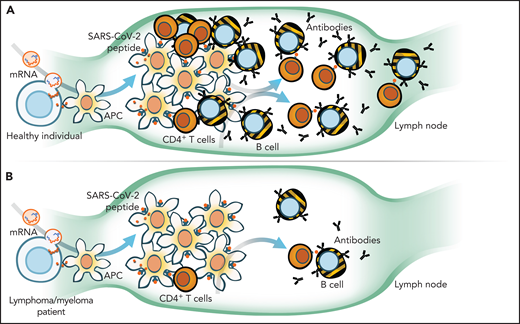 When compared with healthy individuals (A), Liebers et al and Enßle et al in this issue of Blood demonstrate that myeloma and lymphoma patients (B) have reduced total numbers and function of T cells and even fewer B cells to mount an immune response to COVID-19 vaccination. mRNA, messenger RNA. Illustration by Walter Mejia.