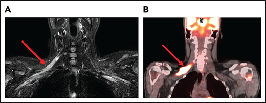 Brachial plexus MRI and FDG-PET scan of a patient with neurolymphomatosis. (A) An axial T1-weighted image after gadolinium contrast shows enhancement of the right brachial plexus. (B) FDG-PET scan shows an increase in FDG uptake in the right brachial plexus.