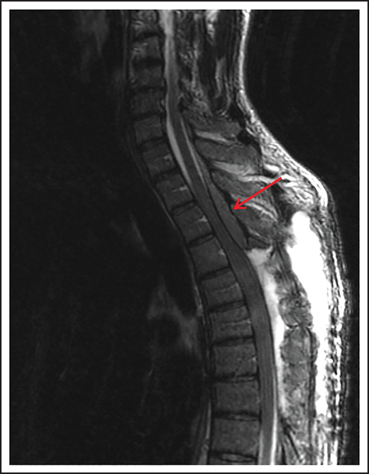 MRI of the cervical and thoracic spine of a patient with epidural spinal cord compression. A sagittal T2 image shows epidural involvement by NHL with compression of the underlying spinal cord.