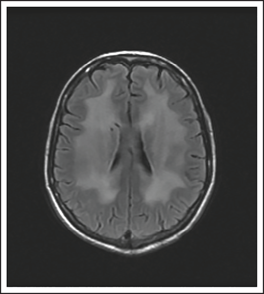 Brain MRI of a patient with leukoencephalopathy caused by use of HD-MTX. An axial T2 fluid attenuated inversion recovery (FLAIR) image shows periventricular hyperintense signal reflecting leukoencephalopathy.