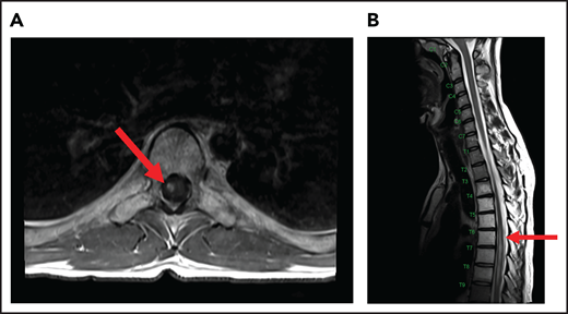 MRI of the cervical and thoracic spine of a patient with radiation-induced myelopathy. (A) Axial T1-weighted image after gadolinium contrast shows enhancement within the spinal cord. (B) Sagittal T2 image shows a signal change throughout the patient’s prior radiation portal from T5 to T9, demarcated by fatty marrow replacement between the T5 and T9 vertebral bodies.