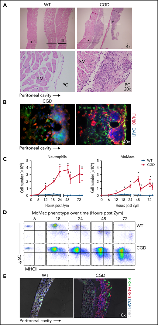 The diaphragm is a site of MoMac accumulation in CGD mice. (A) Hematoxylin and eosin–stained sections of diaphragm collected at 72 hours post–zymosan injection (post Zym) from WT (n = 3 mice shown, labeled i-iii) and CGD (n = 2 mice shown, labeled iv-v). Images captured at 4× magnification (top) or 20× (below). SM denotes diaphragm smooth muscle, PC denotes the peritoneal cavity. (B) Immunofluorescence staining of F4/80 with Ly6G (left) or Fibrin(ogen) (right) of diaphragm tissues from CGD mice at 72 hours after zymosan injection. Images were captured at 40× magnification, and orientation of the tissue with respect to the peritoneal cavity is indicated by the arrow below. (C) Quantitation of neutrophils (left) and MoMacs (right) from digests of diaphragm-associated tissues over time after zymosan injection. Graphs show mean ± standard error with n = 3 to 6 mice per group representative of 2 independent experiments. (D) Phenotype of MoMacs recovered from digests of diaphragm tissue over time post Zym. (E) Immunofluorescence analysis of diaphragm tissues from WT and CGD mice at 42 hours post Zym from animals also treated with i.p. PKH at 18 hours post Zym. Original magnification, 10×. Green arrows indicate PKH-labeled MoMacs. *P < .05. DAPI, 4′,6-diamidino-2-phenylindole; DIC, differential interference contrast.