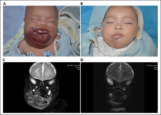 Lesion response assessed by MRI. (A) KHE associated with KMP in a 2-month-old boy (patient 5618). He was treated with a combined therapy of sirolimus and prednisolone. (B) After 12 months of treatment, the reddish skin disappeared and evolved in size. (C) Coronal T2-weighted MRI changes in lesions before treatment. (D) A good lesion response was noted at month 12.