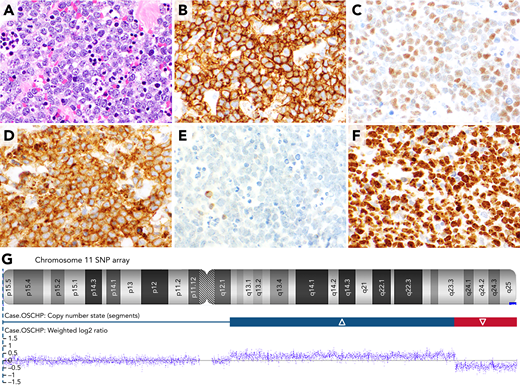 A 26-year-old-man presented to the hospital with abdominal pain. Abdominal imaging showed acute appendicitis, and the patient underwent an appendectomy. The appendectomy specimen showed extensive involvement of the wall of the appendix by a diffuse infiltrate of medium-sized atypical lymphocytes with abundant coarse apoptotic debris in the background, which imparted a “starry-sky” appearance to the infiltrate (panel A; hematoxylin and eosin stain, ×40 objective; total magnification ×400). By immunohistochemistry, the atypical lymphocytes expressed CD20 (panel B; ×40 objective; total magnification ×400), c-Myc (panel C; ×40 objective; total magnification ×400), and CD10 (panel D; ×40 objective; total magnification ×400) and lacked BCL2 (panel E; ×40 objective; total magnification ×400). In addition, the atypical cells expressed BCL6 and lacked TdT, CD34, MUM1, and EBER. Ki-67 showed a very high proliferation rate of >95% (panel F; ×40 objective; total magnification ×400). Fluorescence in situ hybridization (FISH) for a MYC rearrangement was negative, and single-nucleotide polymorphism (SNP) array revealed a proximal (centromeric) gain in segment 11q12.1-q23.3 and distal (telomeric) loss in segment 11q23.3-qter on the long arm of chromosome 11 (panel G; SNP-array results for chromosome 11). The case was diagnosed as Burkitt-like lymphoma with 11q aberration.