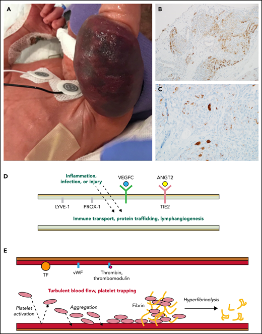 Activated lymphatic and capillary vessels in KHE with KMP. (A) Rapid expansion and infiltration of KHE in response to inflammation, infection, or injury. (B) D2-40+ histologic stain ×20 view reveals abnormal lymphatic vessels. (C) CD61+ histologic stain ×40 view reveals platelet trapping within abnormal capillary vessels. (D) Upregulated and overexpressed signaling from activated abnormal lymphatic endothelium results in increased vessel immune transport, protein trafficking, and lymphangiogenesis. (E) Turbulent blood flow within abnormal capillary vessels results in activated endothelium, consumptive platelet trapping, and hyperfibrinolysis causing KMP. ANGT2, angiopoietin-2; TF, tissue factor; vWF, von Willebrand factor.