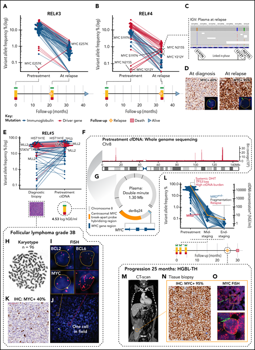 Subclonal point mutations and genomic catastrophes of MYC are associated with refractory subclones. (A,B) Dot and line graphs of somatic point mutations in patients (A) REL#3 and (B) REL#4 according to their VAFs (y-axis, logarithmic) in plasma samples drawn at diagnosis and at relapse. Lines connect the same mutations. Labels show all the exonic mutations detected by explorative genotyping of relapse plasma samples that were not detected in pretreatment samples. Also, an MYC SNV (S197N) detected subclonally at diagnosis is annotated in (B). Swimmer plots below the dot plots demonstrate clinical courses and time points of the plasma draws. (C) IGV screenshot showing reads spanning the relapse emerged MYC SNVs phased with an ancestral MYC SNV in the relapse plasma sample of REL#4. (D) Representative figures of MYC immunohistochemical (IHC) staining in primary and relapse tissues of REL#4. Relapse tissue biopsy is concurrent with the sequenced relapse plasma sample. Inlets show fluorescent images of representative cells in the analyzed tissues hybridized with FISH break-apart probes for MYC locus. Arrowheads denote break-apart signals. (E) Dot plot of somatic point mutations according to their VAF (y-axis, logarithmic scale) in the diagnostic biopsy and pretreatment plasma ctDNA of patient REL#5. Lines connect the same mutations. Nonsynonymous mutations of genomic driver genes are labeled excluding those of BCL2. (F) Bar plot showing the sequencing depth of chromosome 8 in WGS data of REL#5 pretreatment cfDNA. Note the exceptional spikes in coverage that give away high-level amplification of these sequences. One thousand base pair binning. (G) Scaled schematic representation of the completely solved structure of 1.30 megabase amplified double minute detected with plasma pretreatment cfDNA WGS. The double minute contained DNA derived only from chromosome 8, carried 7 novel junctions (black lines), and encompassed an intact MYC gene with hybridization sequences for centrosomal MYC break-apart probe (orange color annotation). (H-J) Genomic analysis of the complex karyotype in the diagnostic biopsy of REL#5. (H) Representative G-banding analysis showing near tetraploid corresponding karyotype (n = 96). (I) Representative cells from the FISH analyses: BCL2 and BCL6 with multiple break-apart signals and MYC with tetrasomy of 8 corresponding signals without a rearrangement. (J) Fluorescent image of MYC FISH showing a microscopy field in REL#5 diagnostic tissue with 1 single cell (red dashed box, inlet) detected carrying amplified double minute corresponding additional red fluorescent signals. (K) MYC IHC in the diagnostic tissue of REL#5 with 40% tumor cell positivity. (L) Dot and line graph showing individual mutations according to their VAF (blue dots, left y-axis) and ctDNA concentration (orange line, right y-axis) in the plasma samples drawn at different therapy phases of REL#5. Red and blue text annotations denote adverse and favorable risk features in ctDNA, respectively. Swimmer plot below showing timeline of REL#5 plasma sampling and disease course. DHIT, MYC/BCL2 double-hit; MRD, minimal residual disease. Asterisk denotes end-of-therapy ctDNA concentration estimated, although MRD was negative (borderline). (M) CT-scan, coronal section of patient REL#5 at progression showing a large partially necrotic mass near the right psoas muscle. (N) MYC IHC stain in the tissue biopsy taken at the time of progression showing markedly increased MYC immunoreactivity (95% tumor cell positivity) in comparison with the diagnostic MYC IHC stain. (O) Representative archival FISH analysis of MYC locus in the tissue biopsy taken at the time of Innumerable red fluorescent signals corresponding to high-level amplified double minutes in all lymphoma cells. Inlet: representative cell.