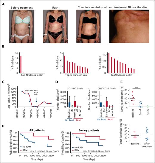 MARs correlate with mogamulizumab efficacy and increased survival in CTCL. (A) Clinical pictures of a patient with MAR before mogamulizumab (far left), at the time of MAR 7 months later (center-left), and in complete remission without treatment after rash (center-right) with close-up on hypopigmented macules consistent with vitiligo minor 18 months after onset of the treatment (far right). (B) Histogram of the top ten T-cell clone frequencies in skin in this patient before mogamulizumab (dominant T-cell clone, left), at the time of MAR 7 months later (middle, polyclonal pattern), and in complete remission without treatment after rash (right, polyclonal pattern) by high-throughput sequencing data of T-cell receptor gene β in skin. (C) Flow cytometry of peripheral blood T cells in this patient showing complete blood remission at the time of rash and 18 months later (<250 CD4+CD26– T cells/mm3). (D) Flow cytometry of peripheral blood CD158k+ (left) and CD4+CD26– T cells (right) in patients treated with mogamulizumab with and without rash showing a sharp decrease in the blood tumor burden (as measured by the absolute number of CD158k+ and CD4+CD26– T cells) at the time of rash (if any) and 3 months after onset of the treatment in both groups. (E) Tumor clone frequencies in patients with rash (upper panel) and no rash (lower panel) at baseline, at the time of first and second rashes, and at baseline and during follow-up, respectively, by high-throughput sequencing of T-cell receptor gene β in skin showing a significant decrease in the skin tumor burden at the time of the first rash; further decrease at the time of the second rash is noted in patients with rash. (F) Kaplan-Meier curves of overall survival in mogamulizumab-treated CTCL patients with (red) and without(blue) rash (upper panel) and in the subgroup of patients with SS (lower panel). ***P < .001. HR, hazard ratio; M3, month 3.