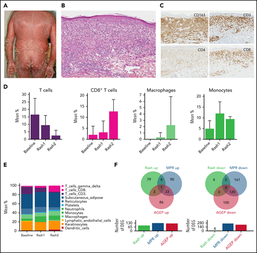 MARs are characterized by macrophage and CD8 T-cell infiltration with a peculiar histologic and gene expression pattern. (A) Clinical picture of a representative patient with MAR. (B) Histopathology of a lesional biopsy specimen of MAR. Magnification ×200; hematoxylin-eosin stain. Granulomatous infiltrate of the upper and mid dermis. (C) Immunohistochemistry (CD3, CD4, CD8, and CD163) on a lesional skin biopsy specimen of MAR. Magnification ×200.The infiltrate comprises macrophages (CD163) and a predominance of CD8 T cells, including intraepidermal CD8 T cells. (D) Histograms of T cell, CD8 T cell, macrophage, and monocyte mean percentages in skin at baseline, first rash, and second rash. (E) Histograms of cell populations: mean percentages in skin at baseline, first rash, and second rash. (F) Venn diagrams of differentially expressed genes (DEG) in MARs compared with MPRs and AGEP.