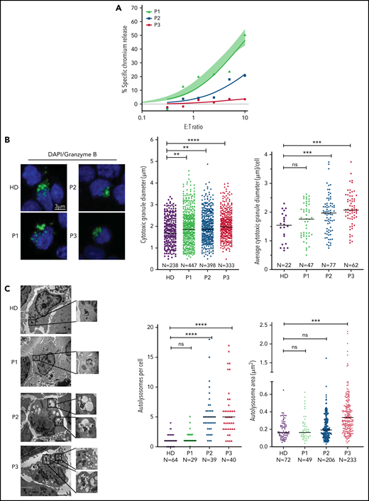 Cytotoxic defects in CTLs from adult patients with NP-C1 are in concordance with the increased formation of autolysosome-like structures. (A) Chromium-51 release assay of activated CTLs against MDA-MB-231 target cells at the effector-to-target (E:T) ratios indicated. Average of 8 HD CTL cytotoxicity assays is shown as shaded area (95% confidence interval). CTLs from patients with NP-C1 (P1-P3) display a spectrum of cytotoxic activities, from normal to severely impaired. (B) Confocal immunofluorescence microscopy shows GzmB (green) vesicles and DAPI (blue) in activated CTLs of HDs and patients with NP-C1. Diameter of CGs was estimated by the computational 3-dimensional reconstruction (Imaris vesicles) based on GzmB staining of CTLs from 2 HDs and 3 patients whose cells had distinctly different cytotoxic activity. (C) TEM images of activated CTLs (scale bar, 2 μm) and zoomed-in autolysosome-like structures (scale bar, 200 nm). Quantification of autolysosome-like structures per cell using n = 30 cells per HD or patient (middle). Quantification of the area of autolysosome-like structures based on GzmB staining (right). Detailed description of microscopy and analysis is provided in the data supplement. **P < .01, ***P < .001, ****P < .0001. DAPI, 4′,6-diamidino-2-phenylindole; ns, not significant.