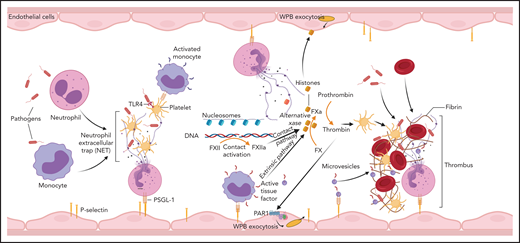 Involvement of immune mechanisms in the propagation of coagulation in DIC. Interaction of pathogens with neutrophils, macrophages, and platelets induces formation of NETs. Components of NETs, such as histones and DNA/nucleosomes, can further amplify the coagulation pathway leading to thrombin generation. NETs and proinflammatory cytokines promote TF expression on monocytes and TF-mediated coagulation. Cell-free DNA supports contact activation and intrinsic coagulation, whereas extracellular histones activate platelets and induce exocytosis of endothelial storage granules, including WPBs and subsequent release of von Willebrand factor and P-selectin, which promote microvascular thrombosis. Thrombin has a similar secretagogue effect. PSGL-1, P-selectin glycoprotein ligand-1.