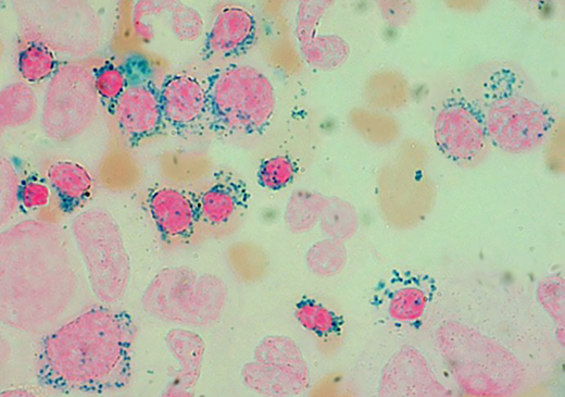 Prussian blue staining of a bone marrow smear from a patient with MDS-RS (Division of Hematology, Fondazione IRCCS Policlinico San Matteo, Pavia, Italy). Ring sideroblasts include both polychromatic and orthochromatic erythroblasts. Original magnification, × 1250.