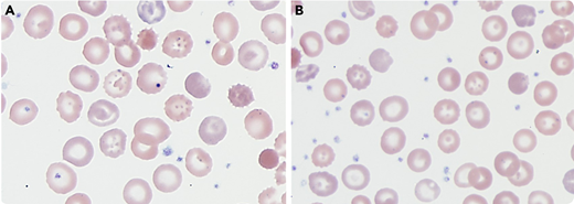 A 4-year-old boy with a history of developmental delay, hypersplenism, thrombocytopenia, transfusion-dependent anemia, and recently identified phosphoglycerate kinase-1 (PGK1) gene mutation (NM_000291.3; variant c.472G>C; p.Gly158Arg) with decreased PGK activity (<17% of normal mean) presented for follow-up 2 months after splenectomy. The patient was receiving blood transfusions every 2 to 3 weeks before splenectomy. After splenectomy, the complete blood count (CBC) numbers were not as critical as before, and no regular blood transfusions were required. His bloodwork showed hemoglobin of 9.6 g/dL, hematocrit 29.2%, red blood cell (RBC) count 2.93 × 106/μL, mean corpuscular volume 99.7 fL, reticulocytes >17.97%, and absolute reticulocyte count 0.5117 × 106/μL.