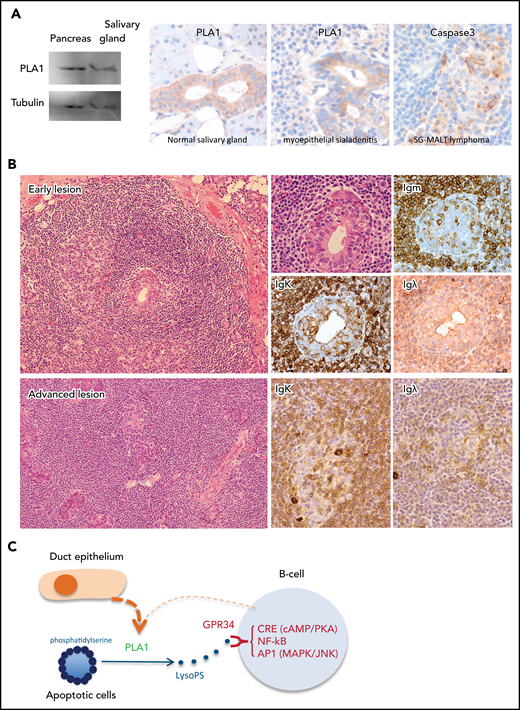 GPR34 activation by paracrine stimulation potentially bridges LELs to the genesis of salivary gland MALT lymphoma. (A) Left: western blot analysis shows PLA1 expression in a salivary gland biopsy specimen, with pancreatic tissue as a positive control. Middle: Immunohistochemistry shows PLA1 expression in the ductal but not acinar epithelium of adjacent normal salivary glands and those involved in LELs in a case of salivary gland MALT lymphoma. Right: Immunocytochemistry for cleaved caspase 3 shows prominent apoptotic activities in LELs in a salivary gland MALT lymphoma. (B) Histology of salivary gland MALT lymphoma. An early lesion shows emergence of neoplastic B cells surrounding the LELs, with some of the neoplastic B cells invading the epithelial gland, as indicated by the immunoglobulin K (IgΚ) light chain restriction. An advanced lesion displays diffuse lymphoid infiltration and prominent LELs with malignant B cells expanding around the LELs. (Images are courtesy of Peter G. Isaacson.) (C) GPR34 activation by paracrine stimulation: PLA1 released by duct epithelial cells of LELs can hydrolyze PS exposed on apoptotic cells, generating LysoPS and hence stimulating malignant B cells via GPR34.