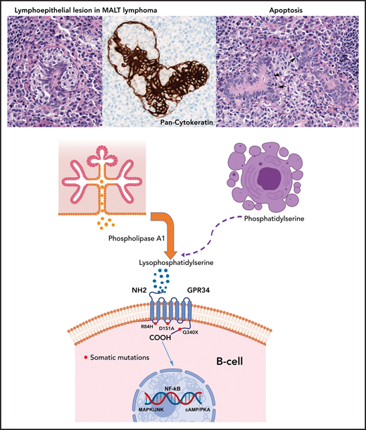 Paracrine GPR34 activation in salivary gland MALT lymphoma. Salivary gland MALT lymphoma (top) with typical lymphoepithelial lesion (left) highlighted by pan-cytokeratin staining (center) and increased apoptotic bodies (right, arrows). Phospholipase A1 is normally secreted by salivary gland epithelia (center left) and catalyzes generation of lysophosphatidylserine from phosphatidylserine exposed on apoptotic cells (center right). Lysophosphatidylserine binds to GPR34 and activates downstream signaling through the NF-κB, MAPK/JNK and cAMP/PKA pathways. The paracrine stimulation is independent of GPR34 mutational status. Red dots mark the location of the GPR34 mutations investigated by Korona et al, with the Q340X mutation in the C-terminal tail showing the most pronounced effects followed by the D151A mutation. The R84H mutation showed an effect similar to that of the GPR34 wild-type.