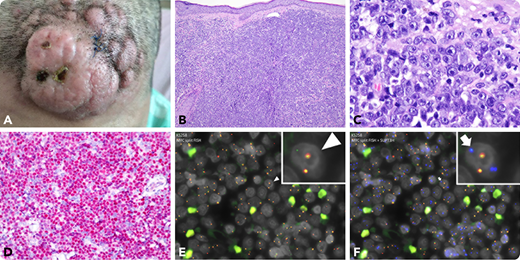 A 53-year-old woman presented with 1 month of a rapidly growing tumor on the forehead that measured 4 × 3.5 cm and had nodular and erythematous appearance (panel A; gross, ×1). A skin biopsy showed the dermis was diffusely infiltrated by a blue cell tumor with a focally starry-sky pattern (panel B; hematoxylin and eosin, 10× objective, total magnification ×100). The tumor cells possessed a moderate amount of cytoplasm and medium-sized to large nuclei with central prominent nucleoli, reminiscent of immunoblasts (panel C; hematoxylin and eosin, 100× objective, total magnification ×1000). Immunohistochemical analysis showed the tumor cells were positive for LCA, CD4, TCL1, and CD123, and negative for CD3, CD20, CD56, CD68, CD138, ALK1, CD30, and MPO, consistent with a diagnosis of blastic plasmacytoid dendritic cell neoplasm (BPDCN). c-MYC was overexpressed (panel D; 40× objective, total magnification ×400). Fluorescence in situ hybridization analysis identified MYC break apart (panel E, arrowhead; green signals, ×600; inset, ×1000) and MYC-SUPT3H fusion (panel F, arrow, blue-green, ×600; inset, ×1000) in more than 70% of the cells, consistent with t(6;8)(p21;q24), which involves MYC but also RUNX2, close to SUPT3H. The patient has completed induction chemotherapy (idarubicin and cytarabine) with tumor regression.