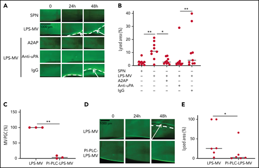 MVs lyse a thrombus in a uPA/uPAR-dependent manner. (A-B) Lysis front retraction experiments were performed with MVs purified from blood and stimulated with LPS (LPS-MVs, 2 × 107) in the presence or absence of α2-antiplasmin (A2AP) at 0.5 µM, an inhibitory anti-uPA antibody at 50 µg/mL and isotype control (IgG) at 50 µg/mL; n = 9. Representative images for each time point (0, 24h, and 48 hours) are displayed in (A); black bar = 1000 µm. The lysis area was calculated at 48 hours, considering the entire thrombus surface (4.3 mm2) using ImageJ software (B). The negative control was represented by the SPN. (C-E) LPS-MVs were treated with phosphatidylinositol-specific phospholipase C (PI-PLC; 2 IU/mL). (C) The MV-PGC of the PI-PLC-treated LPS-MVs (PI-PLC-LPS-MVs) was compared with that of the untreated LPS-MVs (2.5 × 106 MVs). (D) The thrombolytic effect of both types of LPS-MVs was evaluated in the lysis front retraction model at 0, 24h, and 48 hours in the presence of 107 MVs. (E) The lysis area was calculated at 48 hours, considering the entire thrombus surface (4.3 mm2), using ImageJ software; n = 6. *P < .05; **P<.01.