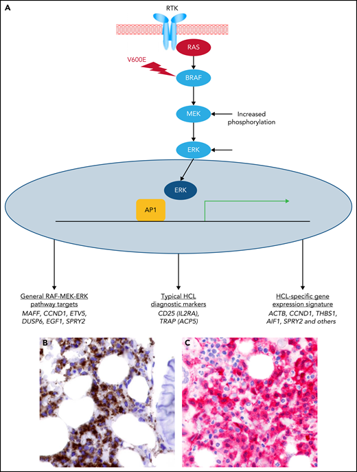 Constitutive activation of the RAS-RAF-MEK-ERK pathway by the BRAF-V600E mutation in HCL. (A) The RAS-RAF-MEK-ERK signaling pathway is physiologically triggered when a ligand binds to its surface receptor tyrosine kinase (RTK). This event, in turn, activates RAS and then BRAF (and CRAF, not shown). BRAF-CRAF heterodimers phosphorylate MEK (MEK1 and MEK2), which in turn phosphorylate ERK (ERK1 and ERK2). The BRAF-V600E mutation renders BRAF constitutively active independently from upstream signals and from heterodimerization with CRAF, thereby deregulating signaling activity. Active ERK enters the nucleus, where it triggers a transcriptional response (for example, through AP1 transcription factors). Such transcriptional response favors cell survival, proliferation, growth, and motility (as well as neoplastic transformation when deregulated by the BRAF-V600E mutation), and comprises genes that are generally induced by the RAF-MEK-ERK signaling pathway as well as genes induced by this cascade in the specific cellular context of HCL, including some of its diagnostic makers and the whole expression signature specific of this leukemia in comparison with normal mature B cells and other peripheral B-cell neoplasms.22 (B) HCL cells (brown) express the BRAF-V600E mutant protein (Ventana immunostaining with VE1 monoclonal antibody; immunoperoxidase and hematoxylin counterstain; ×400). (C) HCL cells express phospho-ERK (red) in the cytoplasm and the nucleus (anti–alkaline phosphatase immunostaining and hematoxylin counterstain; ×400).