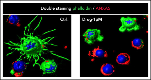 Trimming of HCL projections by BRAF inhibition. Confocal immunofluorescence staining for phalloidin (green), annexin V/ANXA5 (red), and the nuclear dye Draq5 (blue) in HCL cells purified from the peripheral blood of a representative patient with HCL and treated in vitro with vehicle DMSO (Ctrl) or Drug (vemurafenib 1 µM) for 48 hours (363× optical magnification with oil immersion). Upon drug treatment, first the hairy projections (rich in filamentous actin and thus stained in green by phalloidin) almost completely disappear while the leukemic cells are still alive (ie, negative for annexin V; top 2 cells in the right panel); afterward, apoptosis ensues (bottom 4 cells in the right panel). This figure is reproduced from Falini et al.15 DMSO, dimethyl sulfoxide.