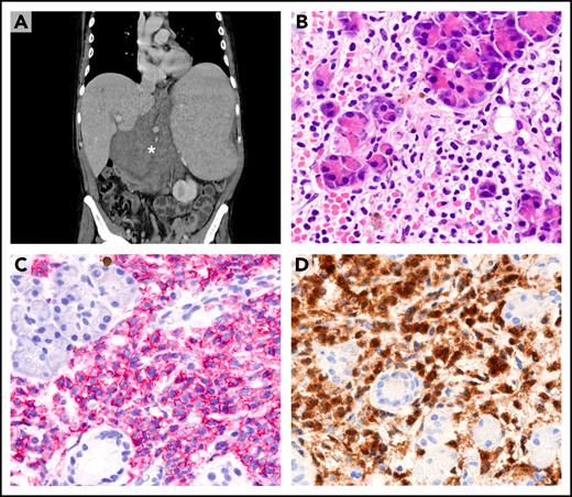 Extramedullary involvement in refractory/relapsed HCL. (A) Computed tomography scan shows a large abdominal mass (asterisk), marked splenomegaly, and enlarged mediastinal lymph nodes (not shown). (B) Needle biopsy of the abdominal mass reveals infiltration of pancreatic glands by morphologically typical HCL cells with wide clear cytoplasm (hematoxylin-eosin; ×400). (C) HCL cells (red) strongly express the CD19 antigen (APAAP immunostaining, hematoxylin counterstaining; ×400). (D) HCL cells (brown) are also annexin-A1+ (immunoperoxidase staining; hematoxylin counterstaining; ×400). APAAP, alkaline phosphatase anti-alkaline phosphatase.