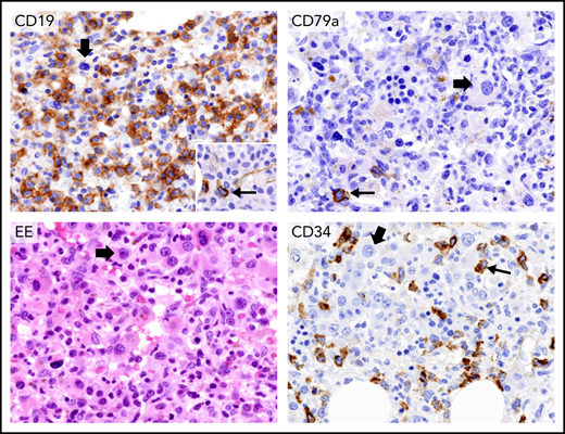 Persistent pancytopenia after therapy with vemurafenib plus rituximab for HCL relapsed following multiple lines of chemotherapy. Upper left panel, immunohistochemical staining of BM biopsy with an anti-CD19 monoclonal antibody before starting vemurafenib plus rituximab shows considerable infiltration by CD19+ leukemic hairy cells (brown). (Leica immunostaining; immunoperoxidase; hematoxylin counterstaining; ×400). Upper right panel, BM biopsy after vemurafenib plus rituximab therapy showing complete disappearance of HCL. The thin arrow indicates a single residual normal CD79a+ plasma cell (brown). The thick arrow points to a monolobated megakaryocyte (Leica immunostaining; immunoperoxidase; hematoxylin counterstaining; ×400). Bottom left panel, the BM biopsy after therapy with vemurafenib plus rituximab shows, on ematoxylin-eosin (EE) staining, a myelodysplastic marrow with many monolobated megakaryocytes (thick arrow). The bottom right panel shows many monolobated megakaryocytes (thick arrow) and a significant percentage of CD34+ blast cells (brown, thin arrow) (Leica immunostaining; immunoperoxidase; hematoxylin counterstaining; ×400). Retrospectively, monolobated megakaryocytes (thick arrow, upper left panel) and an increased number of CD34+ cells (inset in the upper left panel) were present also in the BM biopsy before vemurafenib plus rituximab therapy, but they had been overlooked because of the predominant HCL infiltration.