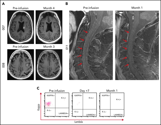 Representative magnetic resonance imaging of responders at baseline and initial time point of best overall response. (A) Patient 007 baseline scan demonstrating a 1.6 cm × 1.3 cm × 1.1 cm enhancing mass within the left posterior caudate body bordering the left lateral ventricle with complete resolution of enhancing lesion at month 4. Patient 008 baseline scan demonstrating a 1.4 cm × 1.4 cm × 0.5 cm enhancing mass in the left middle frontal gyrus corresponding to biopsy proven CNS lymphoma with complete resolution at month 3. (B) Patient 011 demonstrating leptomeningeal enhancement within the spinal cord and (C) CD19+ CD20+ CD5− CD10−/dim leptomeningeal disease with monotypic κ immunoglobulin light chain expression at baseline, day +7 and month 1 demonstrating resolution following tisagenlecleucel infusion.