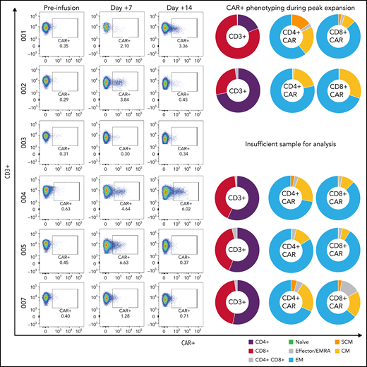 Peripheral CAR-T expansion and phenotyping. Expansion of tisagenlecleucel in peripheral blood and associated CAR-T phenotyping during peak expansion (day +7) demonstrating variable TNaïve, TEMRA, TEM, TCM, and TSCM phenotypes.