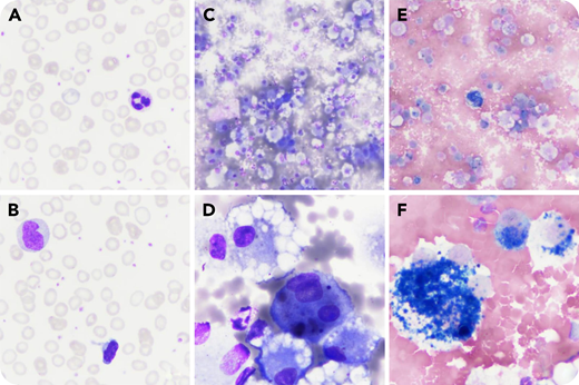 A 14-year-old child presented with nonfebrile dyspnea and hypochromic microcytic anemia without reticulocytosis (hemoglobin, 52 g/L; mean corpuscular volume, 67 fL) with thrombocytosis (524 × 109/L). The blood smear showed dehemoglobinized micro-erythrocytes (microcytic anemia and thrombocytosis) (panels A and B; May-Grünwald-Giemsa stain, magnification x50). Martial deficiency was suspected (serum iron, 3.4 µmol/L; transferrin saturation coefficient, 0.06; C-reactive protein, 13.4 mg/L). Hemoglobin electrophoresis was normal, and the search for glucose-6-phosphate dehydrogenase (G6PD) deficiency was negative. Subsequently, a chest X-ray was performed when respiratory distress with hemoptysis occurred; bilateral and diffuse alveolar infiltrates were observed. An echocardiogram was normal. Cytologic examination of a macroscopically hemorrhagic bronchoalveolar lavage (BAL; panels C-F) revealed the presence of hemosiderin-laden macrophages that suggested a diffuse alveolar hemorrhage (DAH) (panel C: May-Grünwald-Giemsa stain, magnification ×10; panel D: May-Grünwald-Giemsa stain, magnification ×50; panel E: Perls stain, magnification ×10; panel F: Perls stain, magnification ×50). The autoimmune workup was negative. There was no evidence of hypersensitivity to cow’s milk or celiac disease. The diagnosis of idiopathic pulmonary hemosiderosis (IPH) was proposed, and oral prednisone 1 mg/kg once per day allowed improvement of symptoms, correction of anemia, and normalization of the chest radiograph.