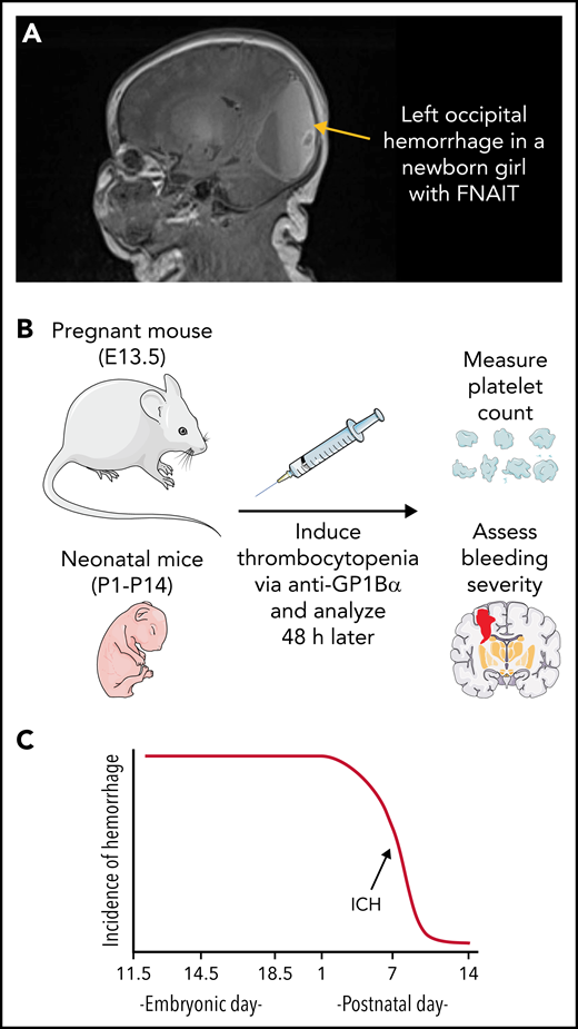 Fetal and neonatal alloimmune thrombocytopenia (FNAIT). (A) Magnetic resonance image (MRI) of a newborn girl with FNAIT caused by anti–HPA-3a. Note the large left occipital hemorrhage containing layering blood of different ages. Hemorrhage was identified on day of birth via ultrasound and confirmed on day of life 1 with MRI showing hemorrhage in the bilateral occipital lobes, left parietal lobe, and right temporal lobe. (B) Overview of the mouse model of FNAIT used by Farley et al. (C) Development of resilience to thrombocytopenia-induced ICH. Cartoons were prepared using adaptations of image vectors from Servier Medical Art (www.servier.com), licensed under the Creative Commons Attribution 3.0 Unported License (https://creativecommons.org/licenses/by/3.0).