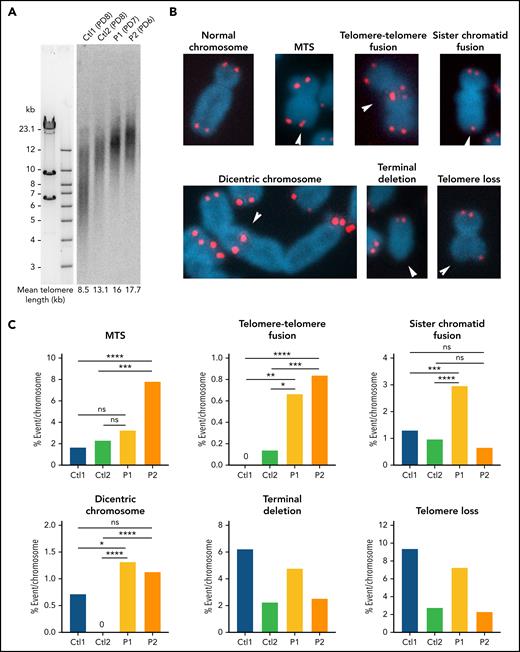 Telomere phenotype in patients' fibroblasts. (A) Telomere length determined by TRF in primary fibroblasts from 2 healthy controls and patients P1 and P2. Population doubling is indicated in brackets. (B) Representative pictures of normal chromosomes and chromosomes with the indicated telomeric aberrations detected by FISH. (C) Quantitative analysis of telomeric aberrations detected by FISH in SV40-transformed fibroblasts from 2 age-matched healthy controls and P1 and P2 at similar passages (from passage 3 to 8). Ctl1 fibroblasts are from a healthy male individual, and Ctl2 are from a healthy female individual). Results from 5 independent experiments for P1 and 2 for P2 (counted chromosomes: Ctl1: n = 1,945; Ctl2: n = 1,462; P1: n = 3,325; P2: n = 2,631). Averages are shown and χ2 tests were applied to compare Ctls with either P1 or P2. *P < .05, **P < .01, ***P < .001, ****P < .0001.