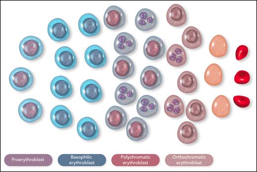 Schematic representation of the cellular composition of ineffective erythropoiesis in β-thalassemia. Most of the erythroid cells are proerythroblasts or basophilic erythroblasts, with an arrest of maturation in the polychromatic erythroblasts; many polychromatic and orthochromatic erythroblasts, exemplified here as cells with a fragmented nucleus, undergo apoptosis. This figure illustrates the notion that ineffective erythropoiesis is characterized by Epo-driven expansion of early-stage erythroid precursors, associated with apoptosis of late-stage erythroid precursors. Erythroid cells were reproduced from Servier Medical Art (smart.servier.com). Professional illustration by Somersault18:24.