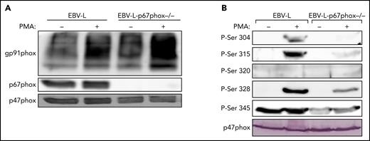 Phosphorylation of p47phox in EBV-transformed B lymphocytes from p67phox-deficient patients and from healthy donors. (A) EBV-transformed B lymphocytes from healthy donors (EBV-L) and p67phox-deficient patients (EBV-l-p67phox−/−) (15 × 106/400 µL) were stimulated with PMA (200 ng/mL) for 10 minutes and the reaction was stopped by denaturation with 100 µL Laemmli sample buffer (5×). Homogenates were subjected to SDS-PAGE and western blotting using anti-gp91phox, anti-p67phox, and anti-p47phox antibodies. (B) EBV-transformed B lymphocytes from healthy donors (EBV-L) and p67phox-deficient patients (EBV-l-p67phox−/−) (15 × 106/400 µL) were stimulated with PMA (200 ng/mL) for 10 minutes and the reaction was stopped by denaturation with 100 µL Laemmli sample buffer (5×). Homogenates were subjected to SDS-PAGE and western blotting using different anti-phospho-p47phox antibodies: anti-phospho-Ser304, anti-phospho-Ser315, anti-phospho-Ser320, anti-phospho-Ser328, and anti-phospho-Ser-345 antibodies and anti-p47phox antibody. Experiments were repeated 3 times.