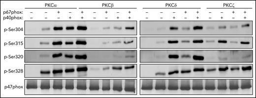 Phosphorylation of recombinant p47phox by purified PKC isoforms in vitro and effect of p67phox and p40phox. Recombinant p47phox protein was incubated without or with p67phox or p40phox or p67phox+p40phox for 10 minutes; PKCα, PKCβ, PKCδ, or PKCζ were added for 5 minutes and the reaction was started by adding ATP, followed by incubation at 30°C for 15 minutes. The reactions were terminated by addition of Laemmli 5× sample buffer and denaturation at 100°C. Proteins were subjected to SDS-PAGE and western blotting using different anti-phospho-p47phox antibodies: anti-phospho-Ser304, anti-phospho-Ser315, anti-phospho-Ser320, anti-phospho-Ser328 antibodies and anti-p47phox antibody. Experiments were repeated 3 times.