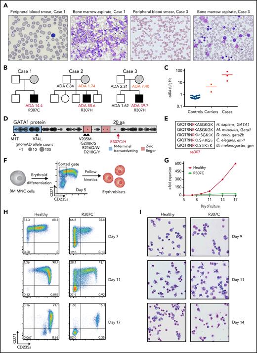 Patients with R307C/H GATA1 mutations display elevated ADA levels and impaired erythropoiesis. (A) Images of May-Grünwald-Giemsa–stained peripheral blood smears and bone marrow (BM) aspirates of indicated cases. (B) Pedigrees of 3 families with cases of congenital hemolytic anemia and elevated erythrocyte ADA (eADA) levels. Measured eADA levels are indicated. In all cases, GATA1 point mutations affecting Arg307 (R307) were identified. (C) Distribution of eADA levels in healthy controls (n = 21), suspected carriers (n = 2), and cases (n = 3). (D) Depiction of reported mutations in GATA1. Previously reported pathogenic variants are indicated with arrows and corresponding amino acid (aa) changes. R307 is in the middle of a 20-aa (black bar) region near the C-terminus. Circles represent projection of variants and their allele count as identified in ostensibly healthy individuals (n = 141 456; gnomAD). DNA binding zinc finger domains and the region around R307 are depleted for variants, indicating coding constraint. (E) aa conservation near R307 for indicated selected species. (F) Schematic of primary cell experiment. BM mononuclear cells (MNCs) from healthy donors and R307C mutant cells were in vitro differentiated into erythroblasts and sorted (gate as indicated), and differentiation and proliferation kinetics were monitored. (G) X-fold expansion of sorted healthy donor and R307C primary cells over the indicated time frame. (H) Flow cytometric plots of CD71 and CD235a surface marker–stained populations of healthy donor and R307C primary cells examined at indicated time points of culture. (I) Images of May-Grünwald-Giemsa–stained cytospin preparations of healthy donor and R307C primary cells at indicated time points of culture (×63 original magnification). Hb, hemoglobin.