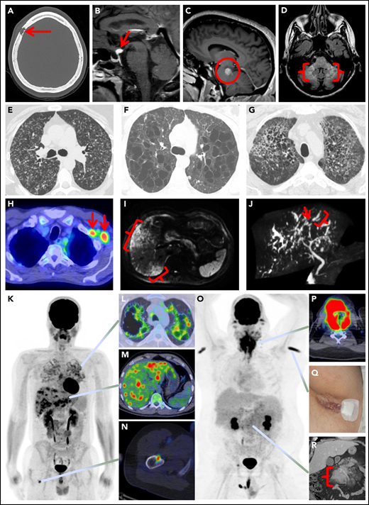 Spectrum of manifestations of LCH in adults. (A) Axial computed tomography (CT) of the calvarium demonstrating a lytic lesion with a beveled edge (arrow). (B) Sagittal pituitary T2 weighted fluid-attenuated inversion recovery (FLAIR) magnetic resonance imaging (MRI) highlighting a hypothalamic lesion with increased FLAIR signal (arrow). (C) Sagittal T1 weighted contrast-enhanced brain MRI demonstrating an enhancing posterior midbrain/pons lesion (circle). (D) Axial brain MRI with a neurodegenerative pattern of T2 signal abnormality throughout the bilateral cerebellar peduncles (brackets). (E-G) Axial CT of the mid to upper chest demonstrating variable appearances of pulmonary LCH to include the most common nodulocystic pattern ground-glass nodules and cysts (E), a cystic-predominant pattern with larger irregular cysts and a few scattered nodules (F), and more confluent combined cystic and nodular disease with architectural distortion consistent with elements of fibrosis (G). (H) Axial fused 18F-fluorodeoxyglucose positron emission tomography CT (FDG PET/CT) of the chest demonstrating 2 FDG avid left axillary lymph nodes (arrows). (I) Diffusion-weighted MRI of the liver demonstrating an infiltrative pattern of increased signal throughout the right hepatic lobe (brackets). (J) Magnetic resonance cholangiopancreatography demonstrating multifocal stricturing (arrow) and dilatation (bracket) of the intrahepatic ducts. (K) Maximum intensity projection FDG PET/CT demonstrating FDG avid advanced pulmonary disease (L), multifocal FDG avid hepatic disease (M), and an FDG avid lytic right femur lesion (N). (O) MIP FDG PET/CT demonstrating an infiltrative FDG avid laryngeal mass (P), bilateral axillary dermal lesions with associated left axillary photograph (Q), and a mildly FDG avid mesenteric mass highlighted with a bracket (R).