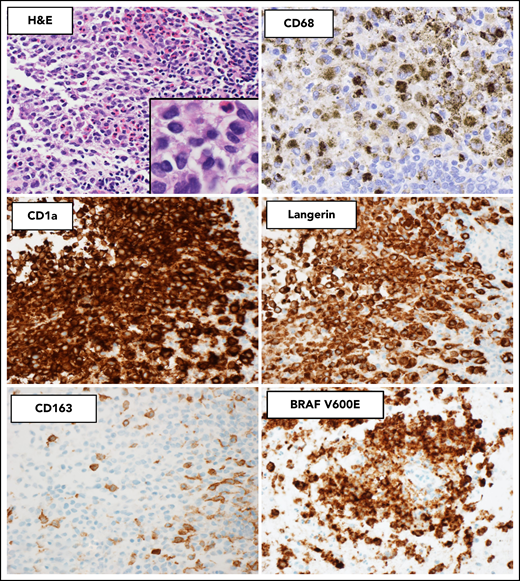 Histopathologic and immunophenotypic features of LCH. The characteristic infiltrate of LCH on hematoxylin and eosin shows mononuclear cells with grooved nuclei and abundant eosinophilic cytoplasm, with a mixture of eosinophils and small lymphocytes. The LCH cells show expression of CD68 (cytoplasmic, Golgi dot-like staining with background macrophages darkly stained), CD1a (surface), and langerin (cytoplasmic) and are negative for CD163. The mutant-specific antibody clone VE1 detects the BRAF-V600E mutation by immunohistochemistry with 2-3+ strong cytoplasmic staining. Images magnification ×400; inset magnification ×600.