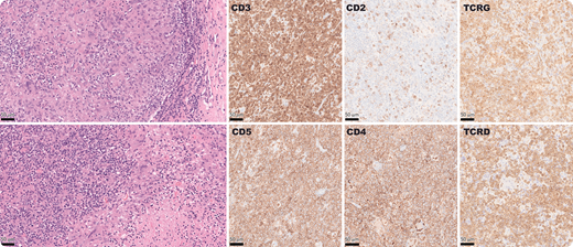 A 78-year-old man presented with multiregional lymphadenopathy and 20-pound weight loss. Inguinal lymph node biopsy showed effaced architecture by a polymorphous population of atypical lymphoid cells of varying size, associated with necrotizing granulomas with multinucleated giant cells and admixed plasma cells. Atypical T cells were positive for CD3, CD5, CD4, CD43, MUM1, TCRD, and TCRG with partial loss of CD2, and CD7, while negative for ALK1, BCL2, BCL6, β-F1, CD8, CD10, CD25, CD56, CD161(NK1.1), CXCL13, ICOS, granzyme B, PD1, TdT, and TIA1 by immunohistochemistry. EBER-ISH and HHV8 were negative. No microorganisms were detected. Polymerase chain reaction showed clonal TRG, IGH, and IGK gene rearrangement within a polyclonal background. TSO500-NGS showed TP53 p.V143M, KDM6A p.S531fs*21, CDKN2A exon1-3 deletion, and CDKN2B exon1-2 deletion.