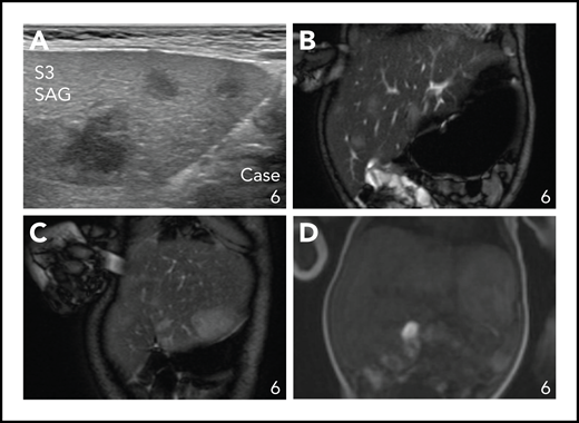 Focal liver lesions in an infant with multisystemic disease with liver and hematopoietic involvement (Group 1A). (A) Ultrasound image showing 3 hypoechoic lesions in liver segment 3. (B-C) Coronal T2-weighted fat-suppressed MRI images showing multiple hyperintense lesions in the liver, including a large rounded lesion in liver segment 3 (C). (D) Coronal T2-weighted contrast-enhanced MRI image showing late contrast accumulation in the large rounded lesion in liver segment 3.
