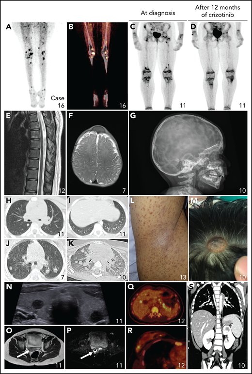 Nonneurologic disease manifestations in ALK-positive histiocytosis patients from Group 1B. (A-D) Fluorodeoxyglucose PET-CT images showing bilateral hypermetabolic long bone involvement, reminiscent of ECD, with objective metabolic response in Case 11 after 12 months of crizotinib. (E) Sagittal image of the contrast-enhanced MRI scan of the spine showing multiple hyperintense lesions in the vertebral bodies. (F-G) Axial MRI image (F) and lateral conventional radiograph (G) showing skull lesions in 2 children, with an appearance reminiscent of LCH. (H-K) Axial CT images showing nodular pulmonary involvement in 3 pediatric cases. (L) Photograph of the right axilla of an adult with a brown maculopapular exanthema that coalesces into plaques and predominates in the axillae and flanks, reminiscent of xanthoma disseminatum. (M) Photograph showing 1 of multiple scalp skin lesions in a child, which can also be observed on the MRI of the head (Figure 4A). (N) Ultrasound image demonstrating round, hypoechoic lesions in both lobes of the thyroid gland. (O-P) Axial T2-weighted (O) and diffusion-weighted (P) pelvic MRI images showing a cervical tumor with restricted diffusion in a child that presented with menorrhagia and irregular vaginal bleeding. (Q-R) Axial PET-CT images showing hypermetabolic focal lesions in the liver and pancreas (Q) and in the breast (R). (S) Coronal CT image showing a focal lesion in the left kidney.