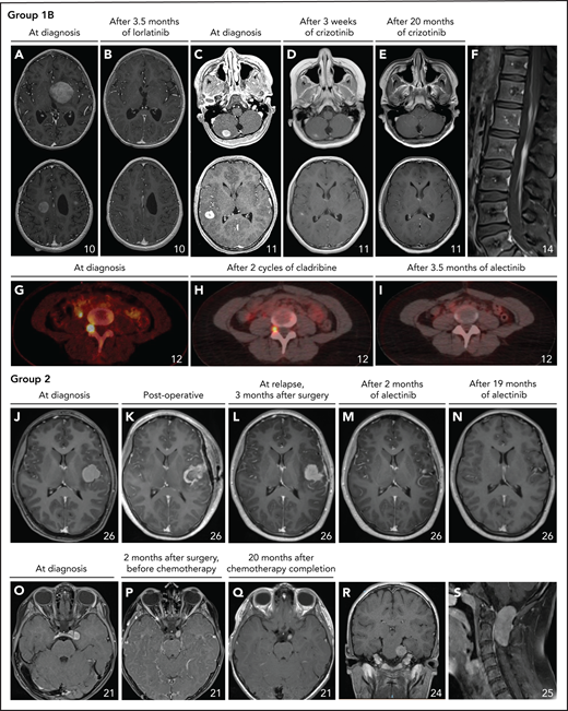 Neurologic involvement in ALK-positive histiocytosis patients from Group 1B or 2. (A-E) Axial images of the T1-weighted contrast-enhanced MRI scans of the heads of 2 pediatric cases with multiple solid brain tumors before and after treatment with ALK inhibition, demonstrating robust responses in both. (F) Sagittal image of the T1-weighted contrast-enhanced MRI scan of the spine showing leptomeningeal contrast enhancement along the descending cauda equina nerve roots. (G-I) Axial images of successive fluorodeoxyglucose PET-CT scans showing partial and complete response of a neuroforaminal tumor at level L5 after 2 cycles of cladribine (H) and subsequent treatment with alectinib (I), respectively. Coronal images (not shown) demonstrated that the tumor followed the course of the exiting nerves, highly reminiscent of nerve sheath tumors such as neurofibromas. (J-N) Axial images of successive T1-weighted contrast-enhanced MRI scans of the head of a child with a left insula tumor before and after subtotal resection and successful treatment with alectinib. (O-Q) Axial images of the T1-weighted contrast-enhanced MRI scans of the head of a child with a left oculomotor nerve tumor, demonstrating slight regression but continued contrast enhancement of the tumor after treatment with vinblastine/prednisone-based chemotherapy. (R) Coronal image of the T1-weighted contrast-enhanced MRI scan of the head showing a 30 × 25 × 34 mm large tumor with contrast enhancement in the prepontine cistern that followed the course of the trigeminal nerve and caused pressure on the pons. (S) Sagittal image of the T1-weighted contrast-enhanced MRI scan of the cervical spine showing a large (18 × 24 × 45 mm) intradural extramedullary tumor at level C1-C2.