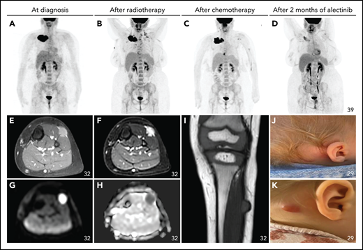 Nonneurologic disease manifestations in ALK-positive histiocytosis patients with single-system disease (Group 2). (A-D) Successive fluorodeoxyglucose PET-CT images of an adult female with a large right clavicular tumor at diagnosis (A; time, 0) and after treatment with radiotherapy (B; time, 5.5 months), 6 weeks of vinblastine/prednisone-based chemotherapy (C; time, 9.5 months), and 2 months of alectinib (D; time, 14 months). (E-I) T1-weighted contrast-enhanced (E), T2-weighted (F), diffusion-weighted (G), apparent diffusion coefficient (H), and plain T1-weighted (I) MRI images of the left lower leg of a child at diagnosis showing a single soft tissue tumor that infiltrates the musculature and shows contrast enhancement and restricted diffusion. (J-K) Photographs of the retroauricular scalp lesion of an infant, with a clear change in clinical appearance after 3 months (K).