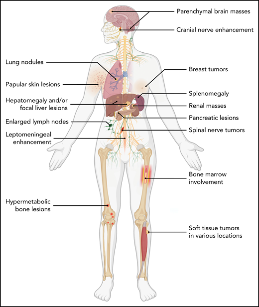 Body diagram showing recurrent anatomic sites of involvement of ALK-positive histiocytosis.