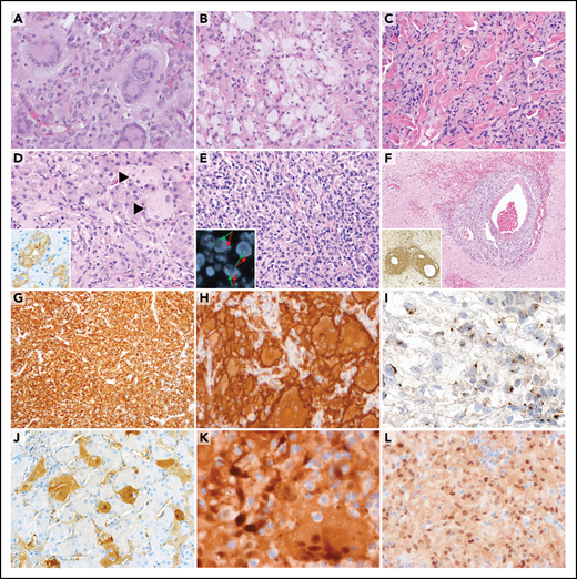 Histopathologic features of ALK-positive histiocytosis. (A) Photomicrograph of the hematoxylin and eosin (HE)-stained slide of a frontal bone tumor (Case 7; original magnification ×200) with classic xanthogranuloma morphology including many Touton giant cells. (B) HE image of a spinal nerve root tumor (Case 15; original magnification ×200) showing abundant lipidized (“foamy”) histiocytes. (C) HE image (Case 31; original magnification ×400) showing a more monomorphic histiocytic infiltrate in the skin dissecting through the dermal collagen bundles. (D) HE image of a liver biopsy (Case 4; original magnification ×400) showing sinusoidal infiltration by large histiocytes (indicated by black arrows) with ALK immunoreactivity (inlet). (E) HE image of a CNS tumor (Case 18; original magnification ×400) with a monomorphic, dense infiltrate of histiocytes that demonstrate separated red and green signals on ALK break-apart FISH analysis (inlet). (F) HE image of a CNS lesion (Case 20; ×100) showing marked infiltration of the perivascular (“Virchow-Robin”) spaces by histiocytes with clear CD163 immunoreactivity (inlet). (G) CD163 immunostain of a CNS tumor (Case 18; original magnification ×200) showing diffuse strong expression by the monomorphic histiocytic infiltrate. (H) ALK immunostain (Case 7; original magnification ×200) showing strong cytoplasmic and membranous staining of lesional histiocytes and Touton giant cells. (I) ALK immunostain of a breast tumor (Case 12; original magnification ×400) showing focal, exclusive dot-like immunoreactivity that could be misinterpreted as negative. (J) S100 immunostain of a liver biopsy (Case 4; ×200) showing immunoreactivity by the large sinusoidal histiocytes. (K) P-ERK immunostain (Case 15; original magnification ×400) showing diffuse positive staining by the lesional cells, as well as clear emperipolesis (intact intracytoplasmic leukocytes). (L) Cyclin D1 immunostain of an oculomotor nerve tumor (Case 21; original magnification ×200) showing cytoplasmic and strong nuclear staining in histiocytes with frequent nuclear indentations.