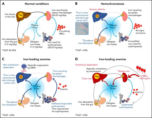 Iron homeostasis in normal conditions (A) and mechanisms leading to iron accumulation in HC (B) and in iron-loading anemias that are nontransfusion-dependent (C) and transfusion-dependent (D). In HC, iron hyperabsorption through the portal vein leads to iron accumulation in liver parenchymal cells, initially with a typical portal-central gradient (see histology) and sparing of macrophages (Kupffer cells). In nontransfusion-dependent anemias with ineffective erythropoiesis, hepcidin insufficiency is also central to the pathogenesis of IO, but it is due to suppression by soluble factors (eg, ERFE) produced by ineffective/expanded erythroblasts rather than to a genetic defect in pathways regulating hepcidin synthesis. In transfusion-dependent anemias, regular red blood cells (RBCs) transfusions represent the major contributing factor to IO; in these conditions, hepcidin is relatively upregulated by iron but fluctuates in response to intermittent erythropoiesis suppression by transfusions.