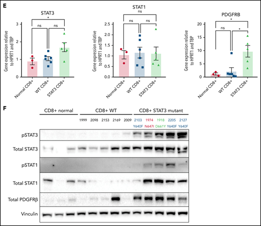 Transcriptomic and protein expression comparison of STAT3-mutated patients against STAT3-WT patients. (A-B) RNA-seq analysis of T-LGL leukemia patients. (A) Volcano plot of DESeq2 output of T-LGL STAT3 mutant vs STAT3 WT. Genes with positive log2 fold changes are more highly expressed in STAT3 mutants, and genes with negative log2 fold changes are more highly expressed in STAT3 WT. (B) Gene set enrichment analysis of the nodes from the functional modular network analysis. Positive enrichment scores indicate pathways that are positively enriched in STAT3-mutant patients. Negative enrichment scores indicate pathways enriched in STAT3-WT patients. (C) RT-qPCR comparison of mRNA levels of ZBTB46, AKT3, and PDGFB from CD8+-isolated normal controls (n = 3; ZBTB46 n = 2 due to signal below the limit of detection in 1 sample), WT (n = 6; ZBTB46 n = 5 due to signal below the limit of detection in 1 sample), and STAT3-mutant LGL patient samples (n = 5). Analysis of variance (ANOVA) P = .028, .014, and .018 for ZBTB46, AKT3, and PDGFB, respectively. (D) Western blotting of pS473 AKT, total AKT, phospho-p44/42 MAPK, total p44/42 MAPK, pS9 GSK3β, and total GSK3β from CD8+-isolated normal controls (n = 3) compared with WT and STAT3-mutant LGL patient samples (n = 5). STAT3 mutation type and LGL registry ID are indicated. (E) RT-qPCR comparison of mRNA levels of STAT3, STAT1, and PDGFRB from CD8+-isolated normal controls, WT, and STAT3-mutant LGL patients. ANOVA P = .049, .963, and .026 for STAT3, STAT1, and PDGFRB, respectively. (F) Western blotting of pSTAT3, total STAT3, pSTAT1, total STAT1, total PDGFRβ, and vinculin loading control from CD8+-isolated normal controls compared with WT and STAT3-mutant LGL patient samples. STAT3 mutation type and LGL registry ID are indicated. Welch’s or Brown-Forsythe ANOVA was used for all RT-qPCR analyses depending on the distribution of the data. Unpaired t with Welch’s correction as a post hoc test. P values are indicated as follows: *P < .05; **P < .01.