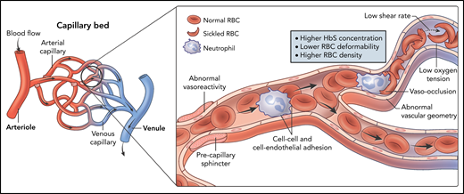 Determinants of blood viscosity in SCD. In vitro models have demonstrated higher whole blood viscosity in SCD blood samples compared with non-SCD samples. The viscosity of sickle blood increases with deoxygenation, low shear rates, and higher HbS concentration, which cause increased HbS polymerization and sickling. Less deformable and denser red cells, as well as increased cellular adhesivity, also raise the viscosity of sickle blood. Additionally, in vivo, vasculopathy and endothelial dysfunction may contribute to increased blood viscosity and vaso-occlusion in the microcirculation.